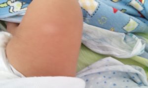 Белое пятно на ноге у ребенка