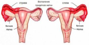 Воспаление яичников или нет