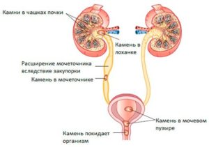 Боли после выхода камня из почки