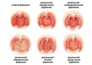 Бессимптомный хронический атрофический фарингит