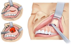 Течет из носа после лечения зуба