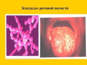 Кандидоз при вич или нет