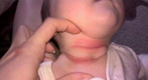 Трещина между ягодицами у ребёнка 5 лет