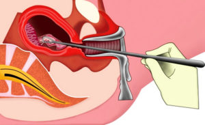 Чистка матки при маточном кровотечении