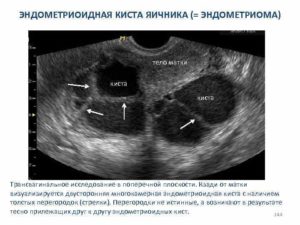 Постоянные боли, эндометриоидная? Киста яичника
