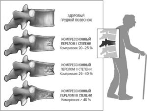 Перелом позвонка s5