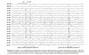 Эпи активность на ЭЭГ ребёнка 3 лет без приступов