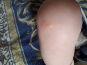 Красное пятно на коленке у ребенка