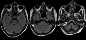 Видно ли на МРТ мозга пазухи носа и возле уха