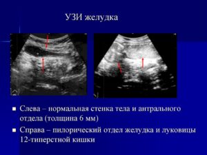На УЗИ желудка обнаружили уплотнение стенок желудка, что это?