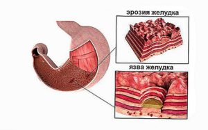 Как принимать лекарства, поверхностный гастробульбит