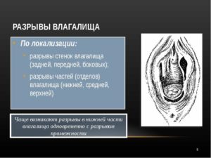 Разрыв влагалища