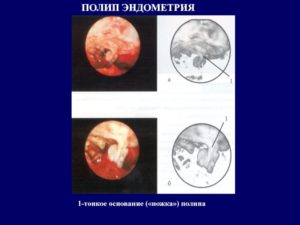 Эндометриальный полип без атипии