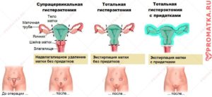 Возможность беременности после удаления матки