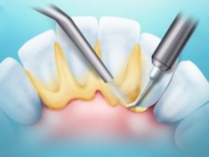 Восстановление десны после удаления зубного камня