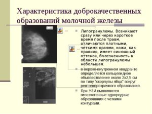 Образование в правой молочной железе