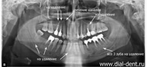 Панорамный снимок зубов расшифровка