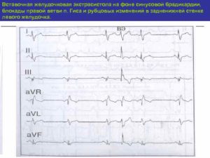 Экстрасистолия на фоне брадикардии
