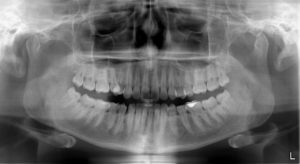 Белое пятно на рентгене челюстного сустава