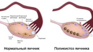 Задержка месячных при поликистозе