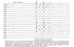 Эпи активность на ЭЭГ ребёнка 3 лет без приступов