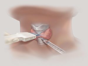 Биопсия узла щитовидной железы