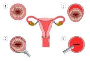 Месячные после конизации
