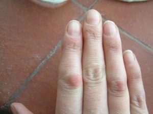 Воспаление фаланги безымянного пальца