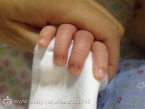 У новорожденного пятно под ногтем пальцев