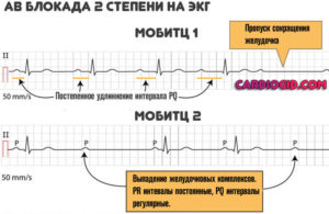 АВ блокады 2 ст. Тип 1 у ребенка, занимается спортом