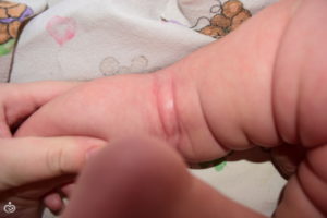 Сыпь и покраснение на яичках у ребёнка