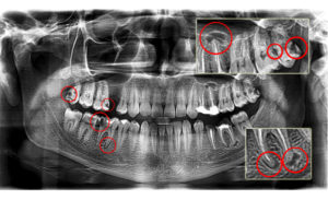 Панорамный снимок зубов расшифровка