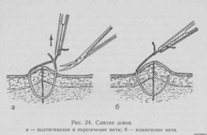 Когда снимать швы после пореза