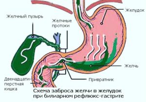 Заброс желчи в желудок