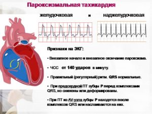 Пароксизмальная тахикардия