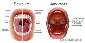 Боль в горле в одном точке, жёлтые пятна