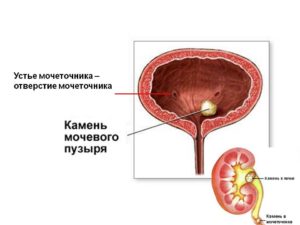 Камень в устье мочеточника