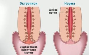 Эктропион шейки матки