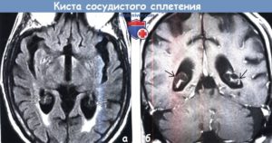 Киста сосудистого сплетения головного мозга