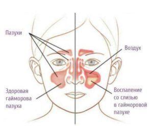 Высокий СОЭ и воспаление придаточных пазух носа