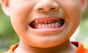 Плохие молочные зубы у ребенка