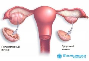 Киста яичника у подростка