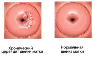 Половая жизнь при лечении цервицита