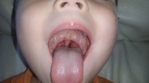 Белые точки в горле у ребенка