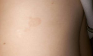Бледно-коричневые пятна на теле у ребёнка