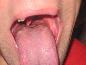 Болит язык у корня