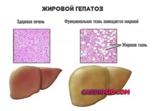 Жировой гепатоз, повышен ггтп