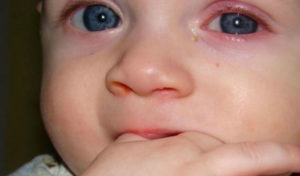 У ребенка от насморка гноится глаз