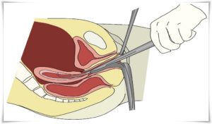 Чистка матки при маточном кровотечении