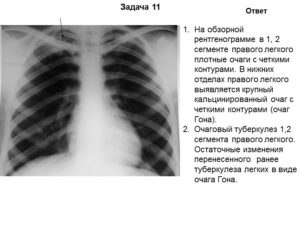 Плотные очаги в легком